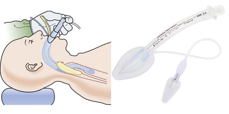 Laryngeal Mask for Anesthesia
